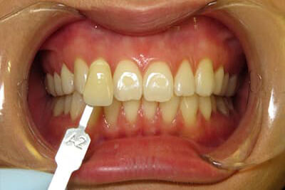 KOR Teeth Whitening Before