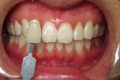 KOR Teeth Whitening After