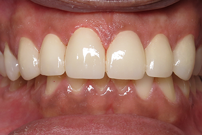 Anterior Crowns After