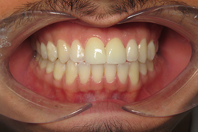 Anterior Crowns 8,9 After