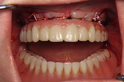Full Mouth Rehabilitation with Implants in 1 day After