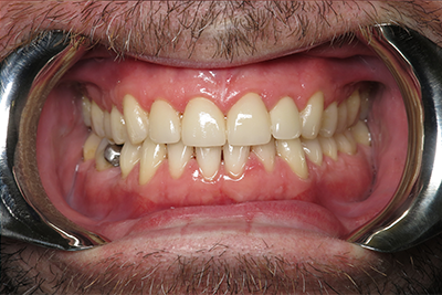 Full Mouth Reconstruction After