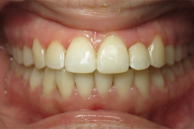 Ortho and Composite Filling After