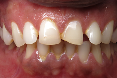 Anterior Crowns Before
