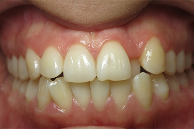 Ortho and Composite Filling Before