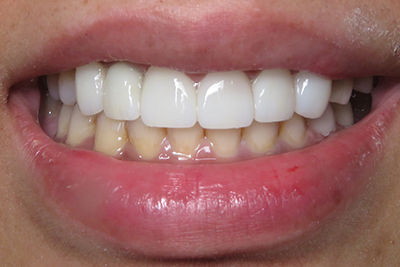 Orthodontics & Veneers After
