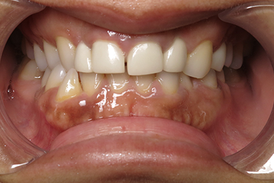 Orthodontics & Veneers Before